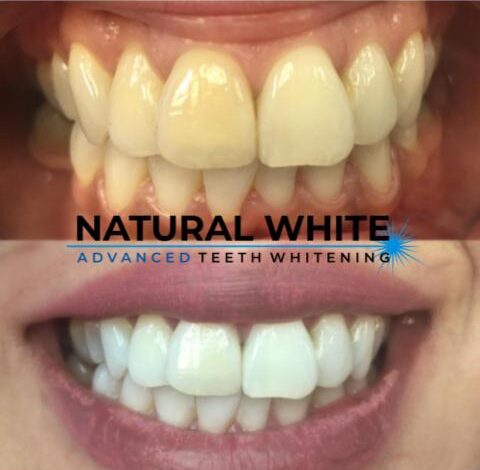 teeth whitening treatment before after