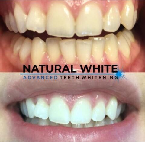 professional teeth whitening results