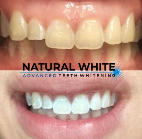 in office teeth whitening results