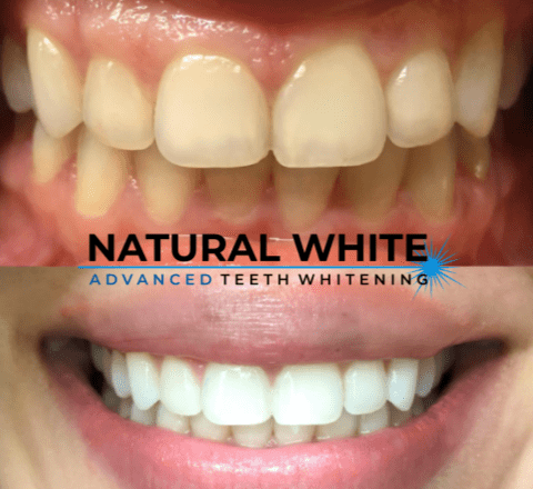 teeth whitening before after