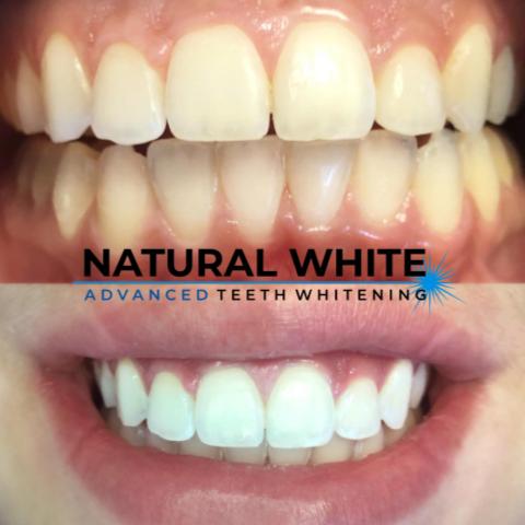 before and after teeth whitening